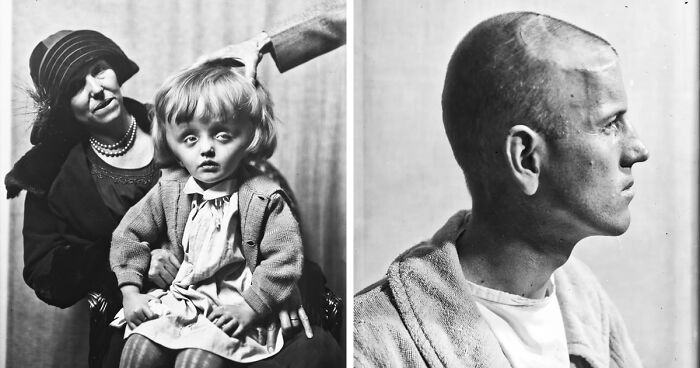 20 Historical Portraits Of Some Of The First Brain Surgery Patients, By Dr. Harvey Cushing