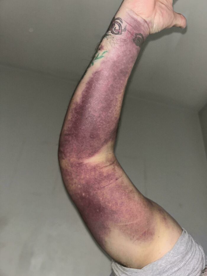 Bruised arm showcasing an interesting medical case, highlighting the resilience and complexity of the human body.