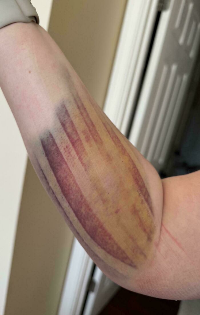 The Bruise On My Arm Healing After K-Tape