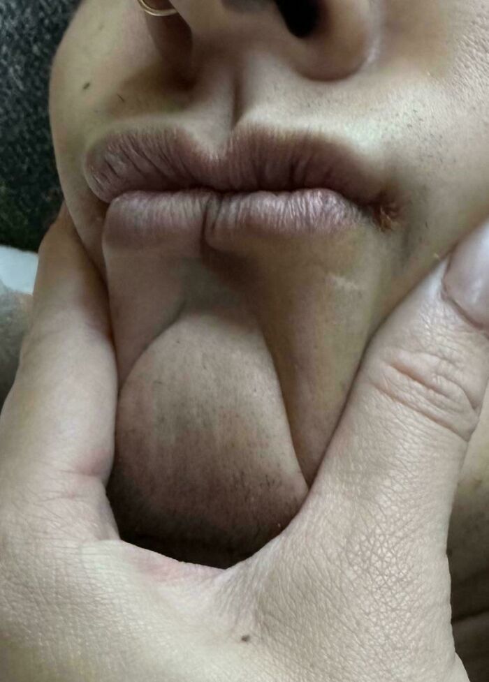 When I Squeeze My Partner’s Mouth Together It Looks Like He Has Two Identical Sets Of Lips Together Side By Side