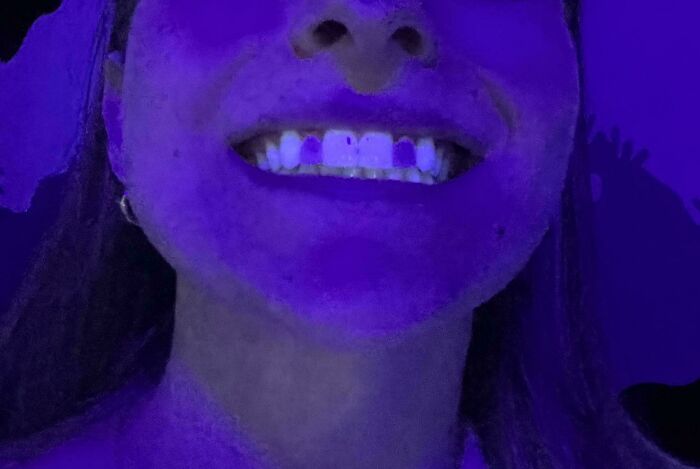 My Two Porcelain Crowns Don’t Glow In Blacklight Like The Rest Of My Teeth