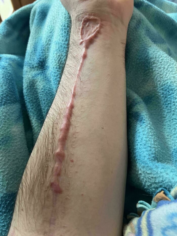 Cicatriz en mi brazo tras sobrevivir a un Esthesioneuroblastoma