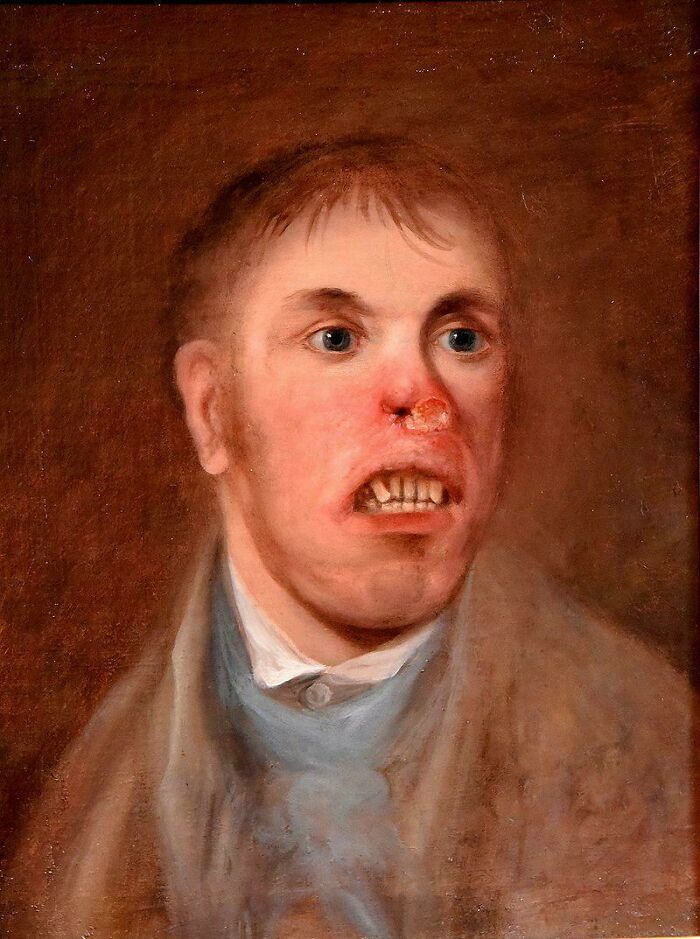Retrato de un hombre afectado de lo que se cree que era sífilis congénita, 1820 aprox