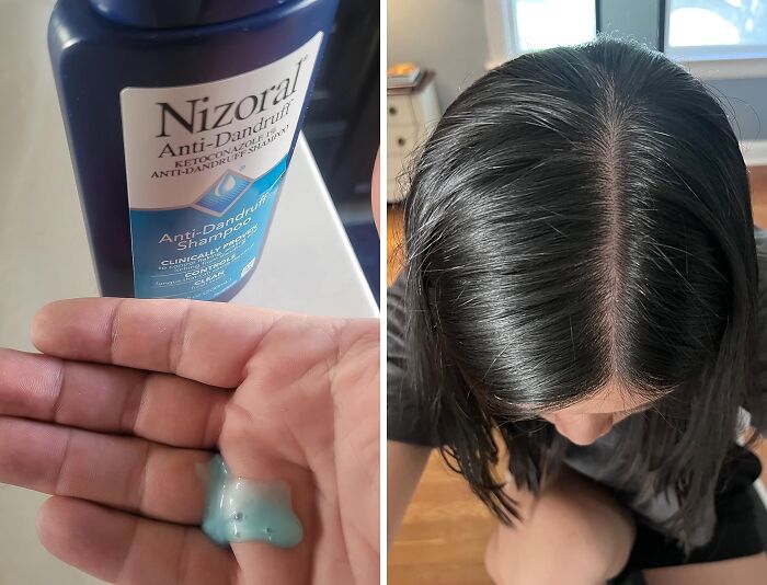  Nizoral Anti-Dandruff Shampoo Stands Out Head And Shoulders Above Its Competitors 