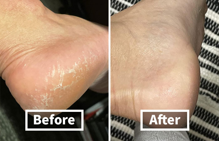 Is Traveling Having Your Pedi Looking Less Than Perfect? Try This Cracked Heel Repair Balm 