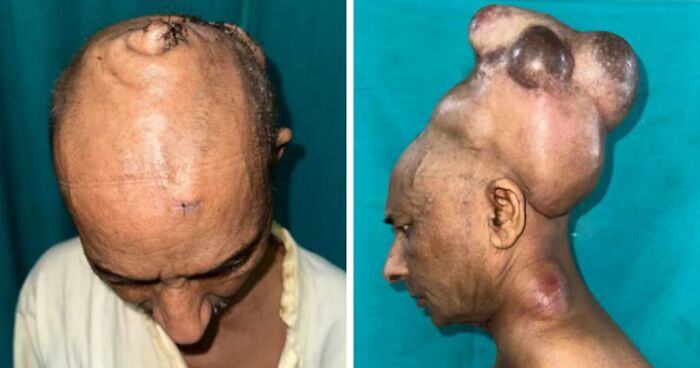 Doctors Perform Intricate Surgery To Free Man Of Heavy Head Tumor Weighing Nearly 7 Kilos