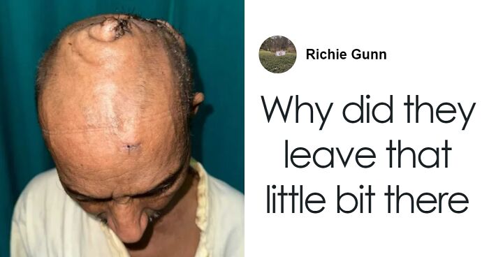 After Living With Massive 15-Lb Head Tumor For 25 Years, Man Undergoes Surgery To Have It Removed