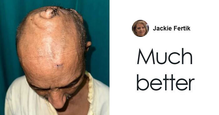 Man With 15-Lb Tumor Requires 10-Hour Operation To Remove It From His Head