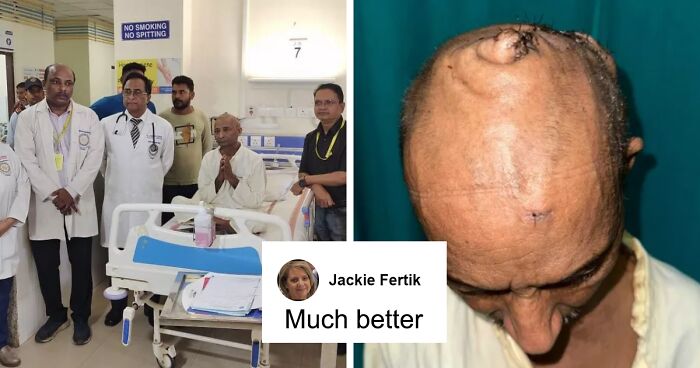 “It Had Been Affecting Him For Over Two Decades”: Surgeons Remove Man’s 15-Lb Head Tumor