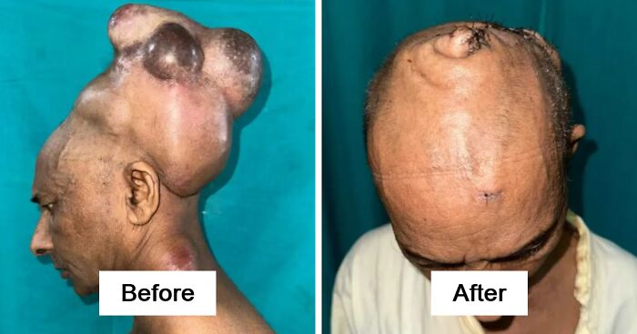 Man Lived 25 Years With Scalp Tumor That Grew To 15 Lbs Before It Was Removed In 10-Hour Operation