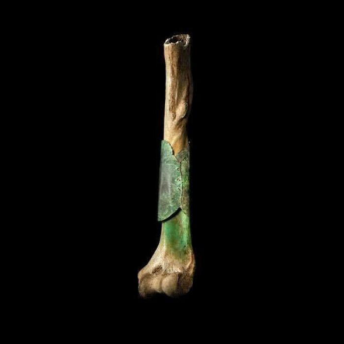 A Medieval Surgeon Repaired This Broken Bone With Riveted Copper Plate