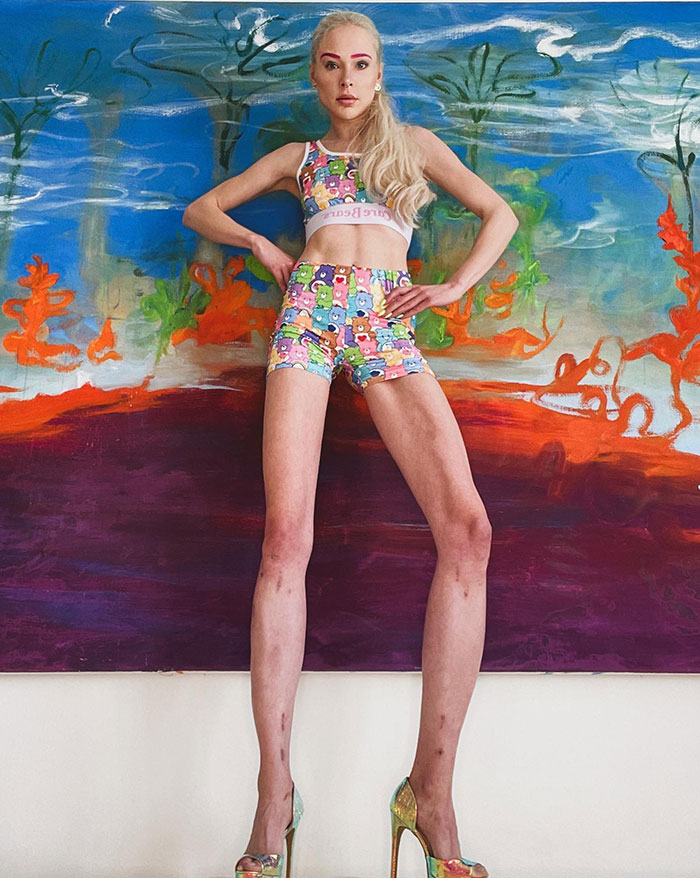 Model Who Spent $160k To Lengthen Her Legs By 5.5 Inches Left With Regrets And Career Problems