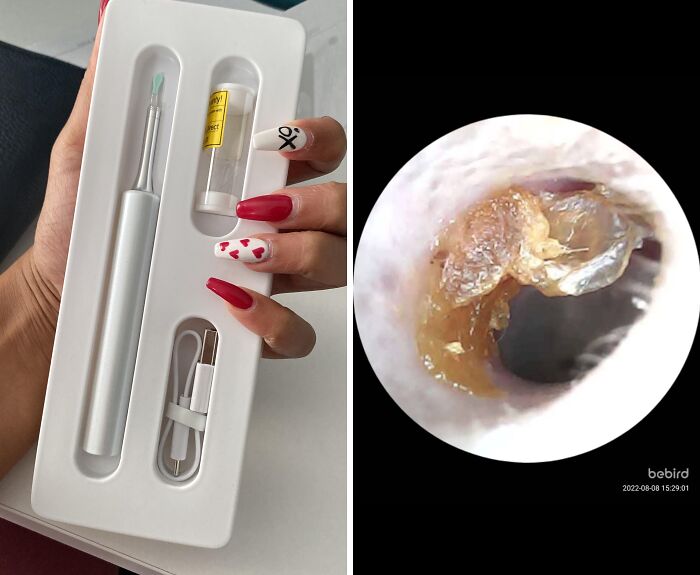 An Ear Wax Removal Endoscope Otoscope Is A Whole New Level For Dr. Pimple Popper Obsessed People