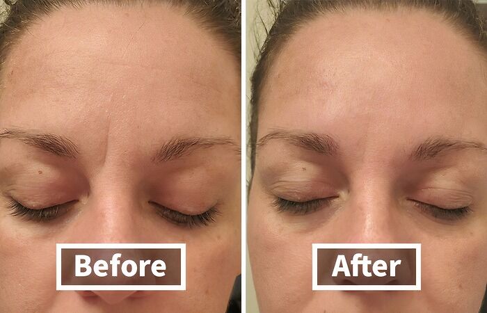  Botox? Nah, Just Stick It To Wrinkles With These Forehead & Between The Eyes Wrinkle Patches