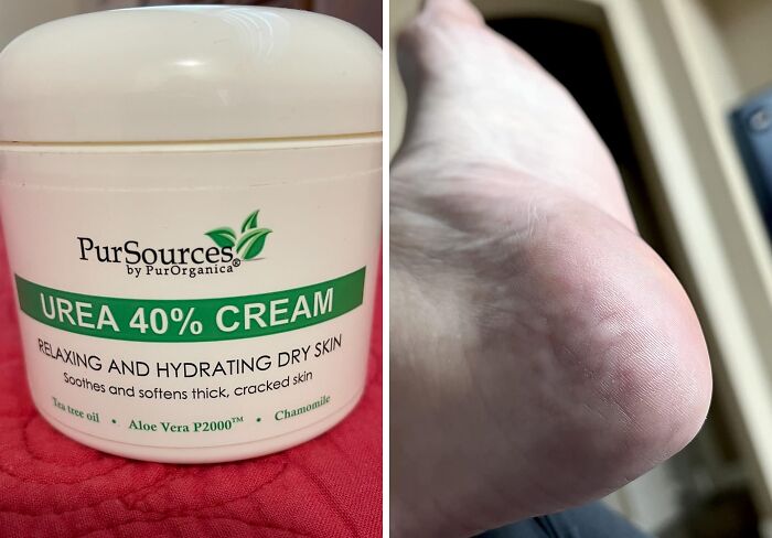  Urea 40% Cream : Crack Down On Dry Skin With This Hydrating Hero