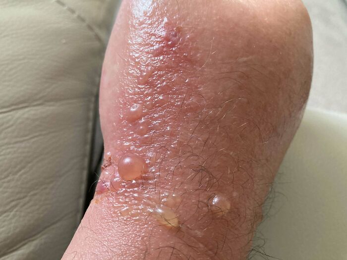 Close-up of a forearm with several raised blisters, illustrating an interesting medical condition.