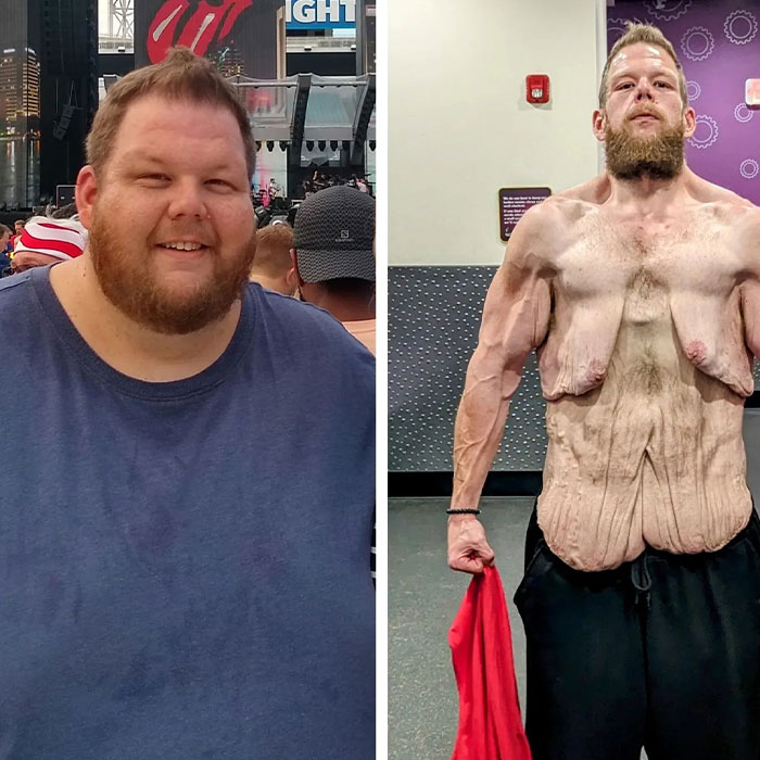 Man Raises $76k To Surgically Remove Excess Skin After Huge Weight-Loss Transformation