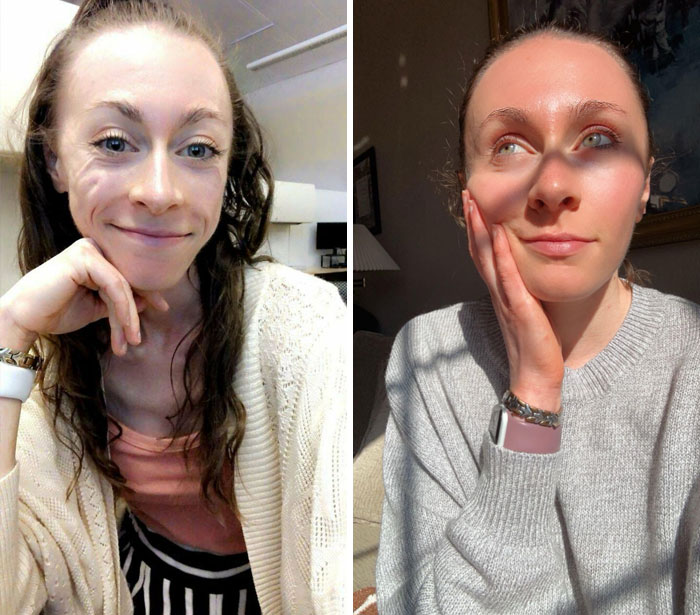 Around A Year Between These Photos. It Took Months In A Treatment Center, Three Relapses And Two More Near-Death Experiences But I’ve Been Recovering From Anorexia On My Own