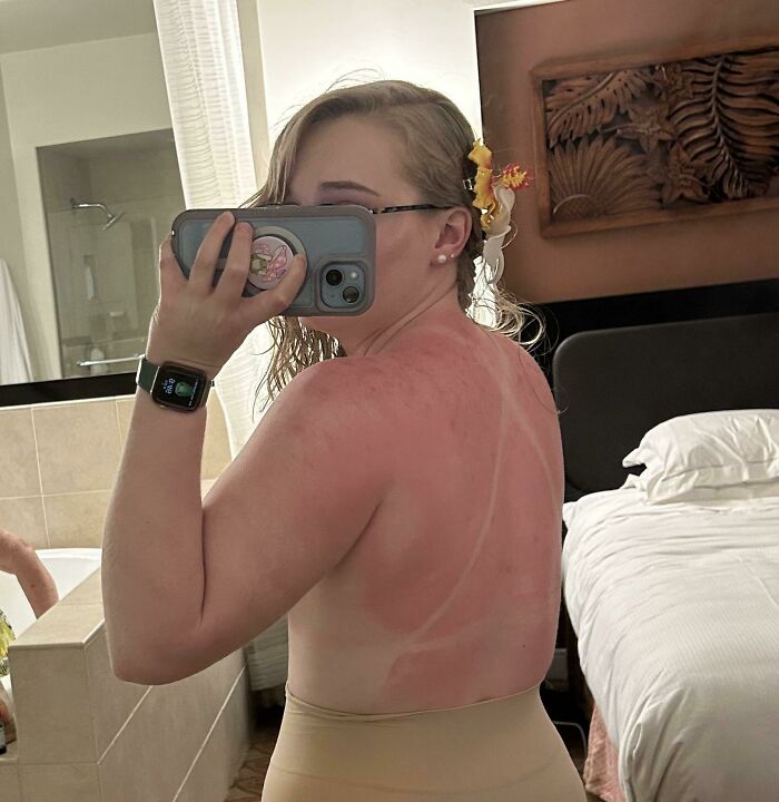 I Recently Went To Hawaii And Got A Gnarly Sunburn As Seen Here. Ended Up Getting A Case Of “Hell’s Itch”, Which Was Genuinely The Worst Pain I’ve Ever Experienced