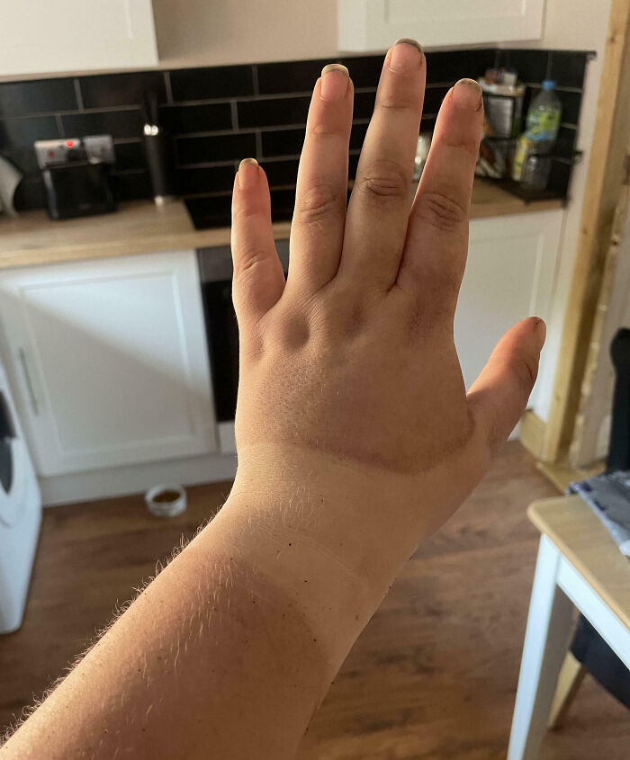 Spent Two Days In The Glorious Sunshine Working Outside And Did Not Anticipate Getting A Tan. Guess I’ll Keep The Thumb Splint On A Bit Longer