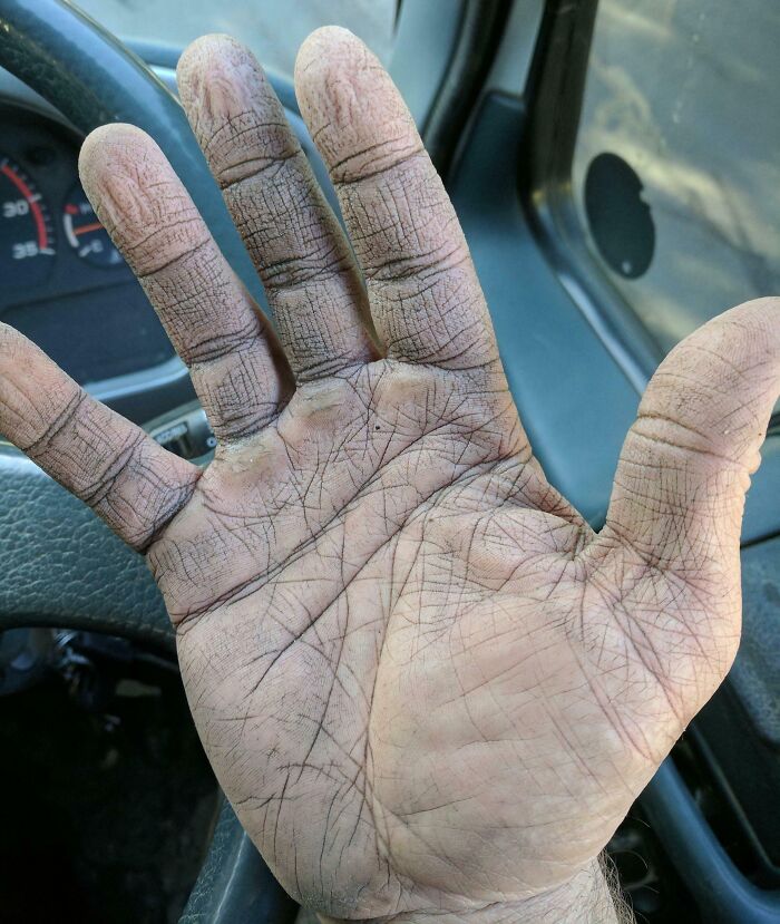 I Pump Concrete For Work, And This Is My Hand After Work. Cement Dust Dries Your Skin Really Badly, So My Hands Are Always Cracked And Dry