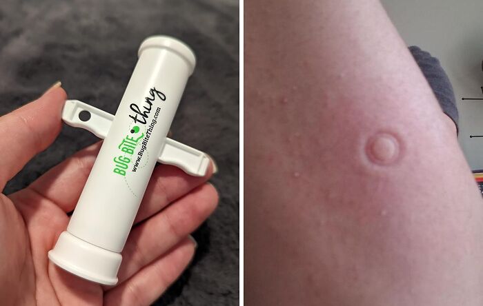 Don't Scratch That Itch, Suck It Up With The Bug Bite Thing Suction Tool