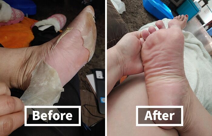  Foot Peel Mask: Shed Your Skin And Your Inhibitions, All In The Privacy Of Your Own Home