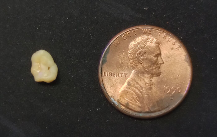 Woke Up To Find This Boulder Of A Tonsil Stone Just Lolling Around On My Tongue