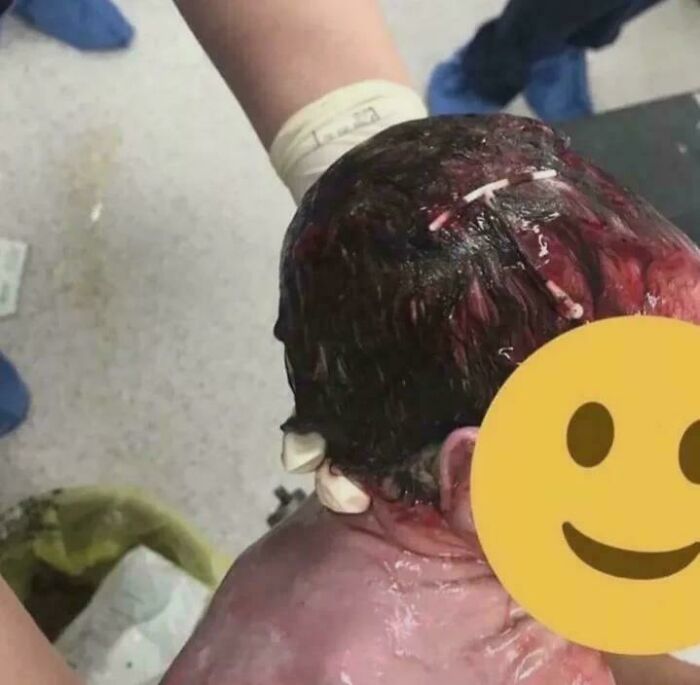 Newborn with unique condition during birth, showcasing an interesting medical case of the human body.