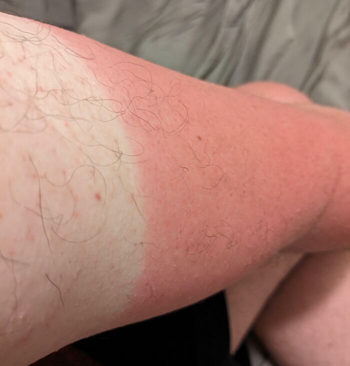 Spent 45 Minutes In The Sun Today Without Sunscreen (Critical Mistake). To Be Fair, I Burn Really Easily Regardless, But Still