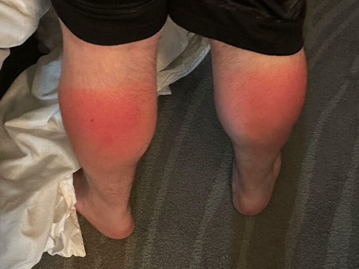 Went To A Music Festival, Got This Gnarly Sunburn