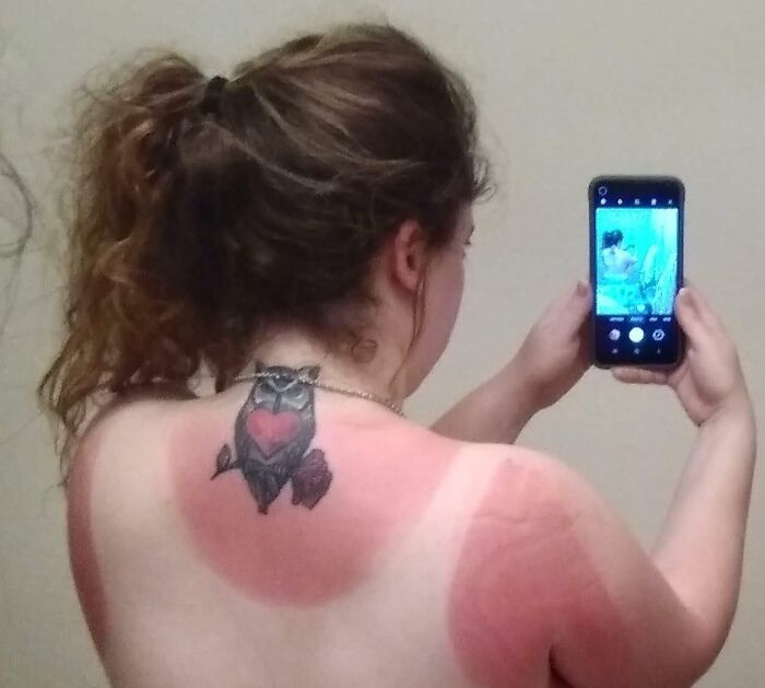 Got The Worst Sunburn Of My Life Immediately After Totaling My Car