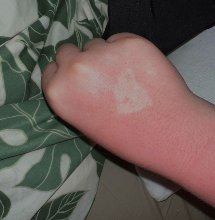 Went To An Amusement Park And Forgot Sunscreen But The Paint They Marked Me With Left A Tan Line