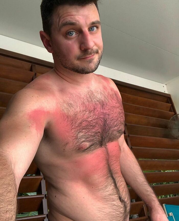 After All These Years, Still Trying To Figure Out How Much Sunscreen To Use 🥵😬 Usually I Don’t Get A Lot Of Sun Under My Hair. Well You Can Clearly See That Theory Didn’t Work For Me This Time