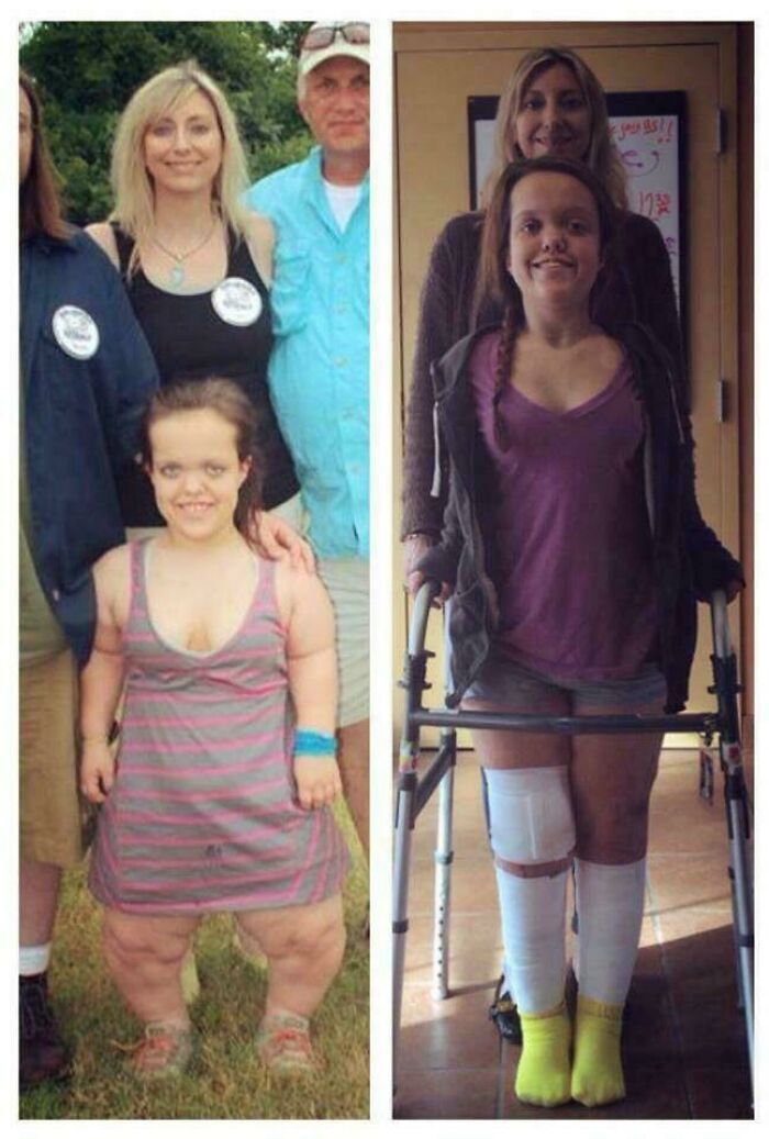 Before And After Limb Lengthening