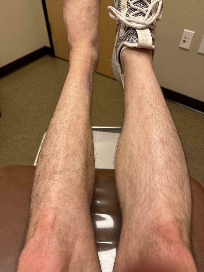 Difference In Leg Size After Two Weeks Post-Surgery