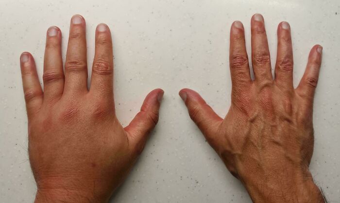 Swollen Left Hand After Insect Bite, Compared To Normal Right Hand