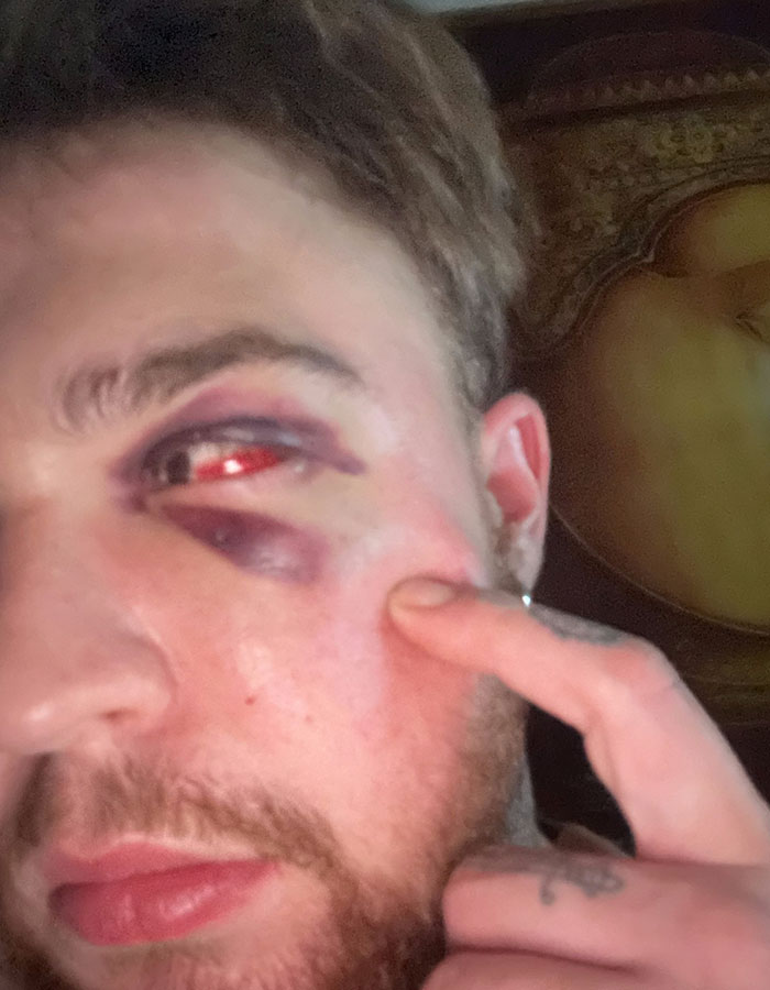 29-Year-Old Trans Man Gets Brutally Beaten Up In Switzerland, Claims It’s A Hate Crime