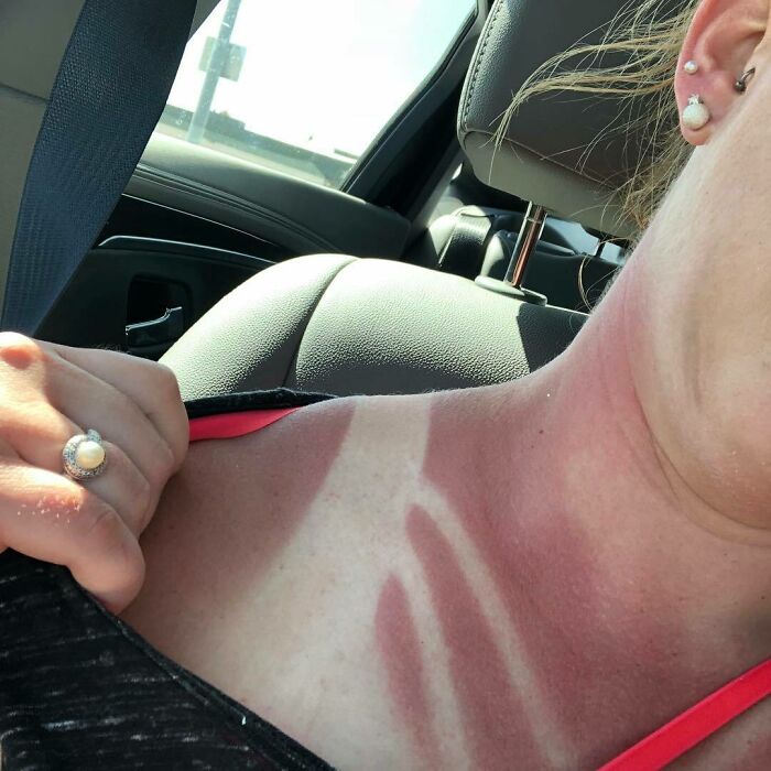 Husker Day Burns. Ouch