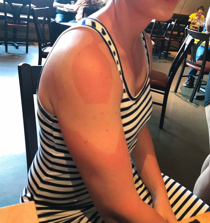 Oh, Your Shoulder Is Sore? You Should Get It Taped, They Said. It Will Help With The Pain, They Said. Except No One Mentioned To Maybe Put On More Sunscreen