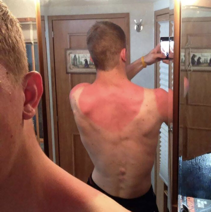 I Came Across This Picture Of A Sunburn I Got When I Was 17 Years Old At A NASCAR Race