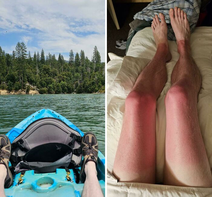 I Forgot To Put Sun Block On My Legs During A Kayak Trip On The Lake