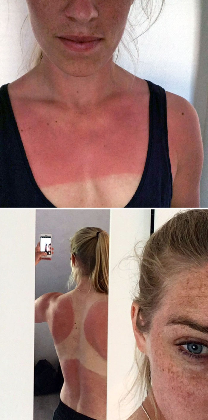 Some Of My Worst Tan Fails. Pro Tip: You Don't Get Tan Lines If You Tan Naked