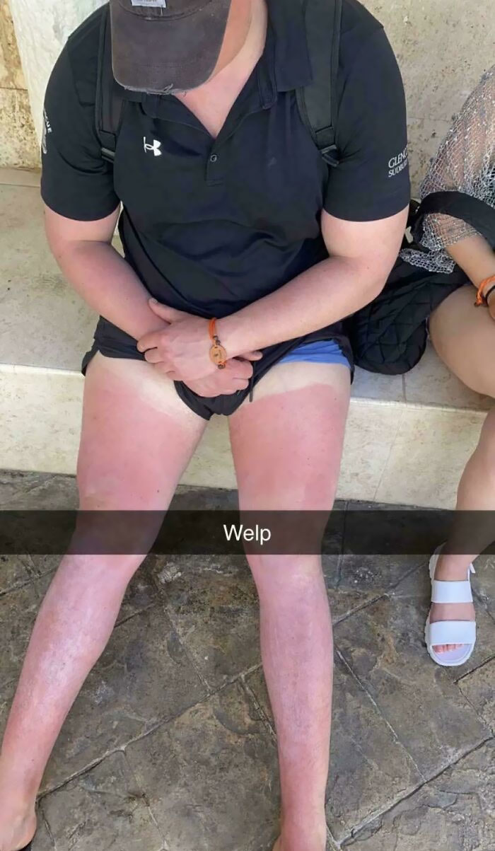 Sunburn On Vacation