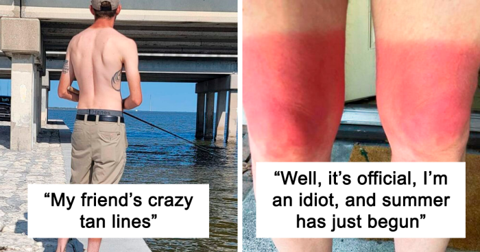 “Someone Didn’t Want To Ask For Help With Their Sunscreen”: 74 Of The Most Unfortunate Sunburns (New Pics)