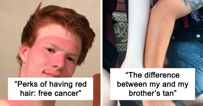 74 Hilariously Painful Sunbathing Fails That Server As The Best Sunscreen Advertisement (New Pics)