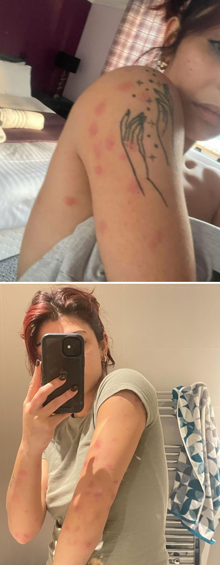 I Stayed At A BnB With Bed Bugs And Had A Huge Allergic Reaction