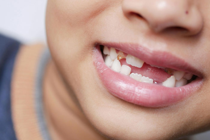 Dad Is Beyond Enraged After Son Has Baby Tooth Pulled By School Nurse For No Good Reason