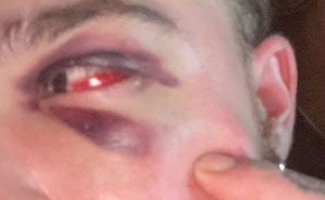 29-Year-Old Trans Man Gets Brutally Beaten Up In Switzerland, Claims It’s A Hate Crime