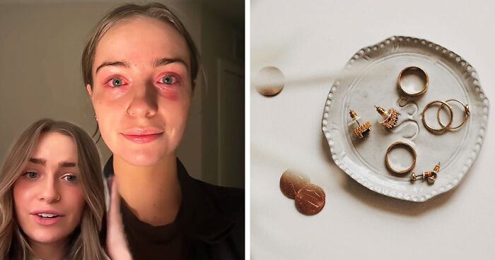 Woman Discovers Her Earrings Have Been Poisoning Her For Months After Doctors Were Stumped